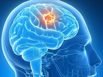 脑癌：颅内“不速之客”，认识与应对是关键
